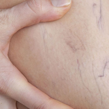 Varices